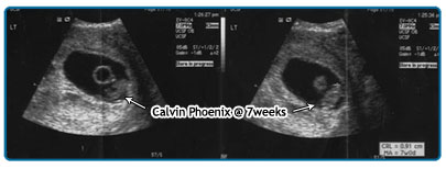 Ultrasound of Calvin Phoenix at 7 weeks