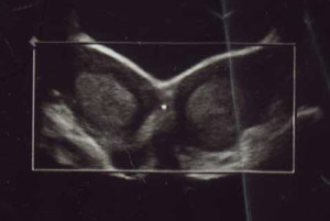 double uterus ultrasound